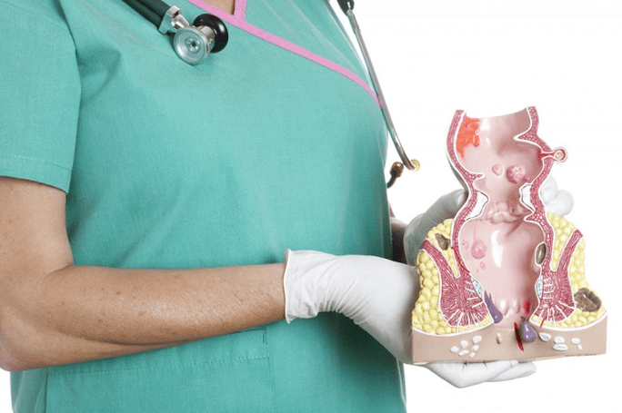 O médico demonstra o modelo hemorróido