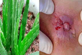 aloe para o tratamento de hemorróidas